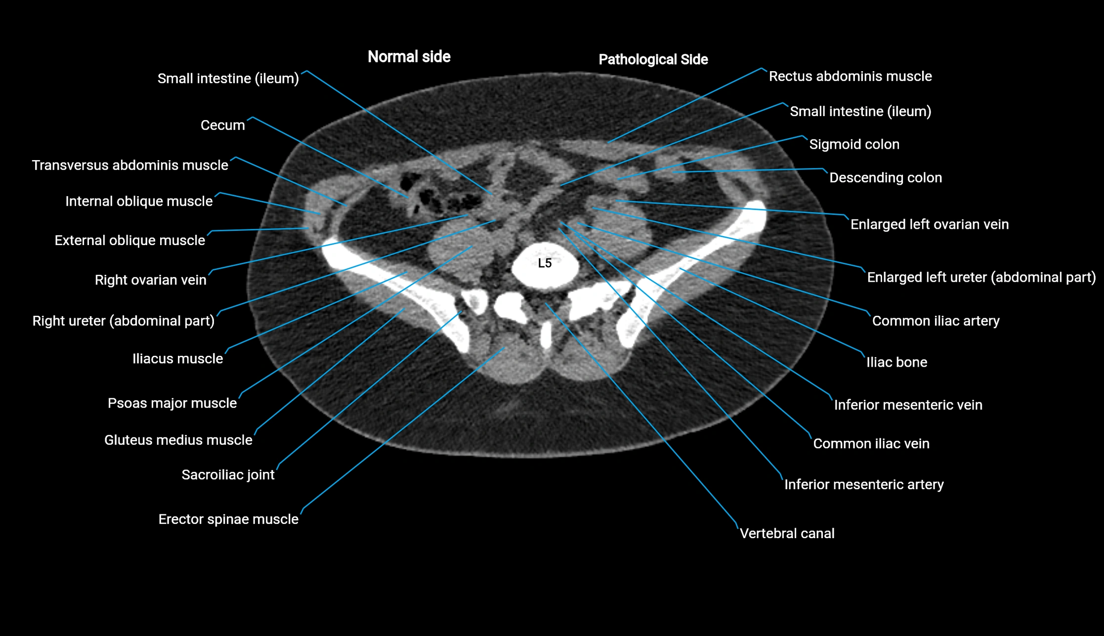 CT KUB axial cross sectional anatomy  radiology image -img-00201-00107.webp